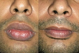 Best Lip Reduction Surgery Treatment Islamabad