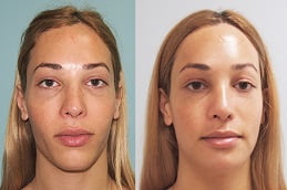 Chin Reduction Treatment Islamabad