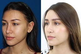Chin Reduction Treatment in Islamabad