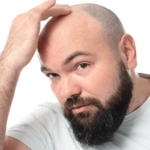 10,000 Grafts Hair Transplant Cost in Islamabad & Pakistan Price