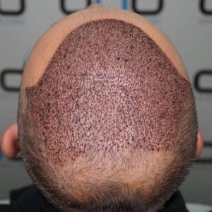 4000 or 5000 Grafts Hair Transplant Cost