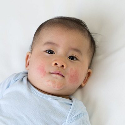 Best Children Skin Issues in Islamabad, Rawalpindi & Pakistan Cost