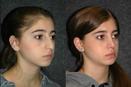 Best Closed Rhinoplasty Clinic in Islamabad