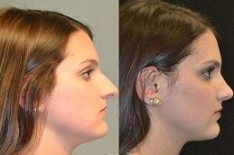 Best Closed Rhinoplasty in Islamabad Pakistan
