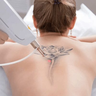 Best Laser Tattoo Removal in Islamabad, Rawalpindi & Pakistan | Cost