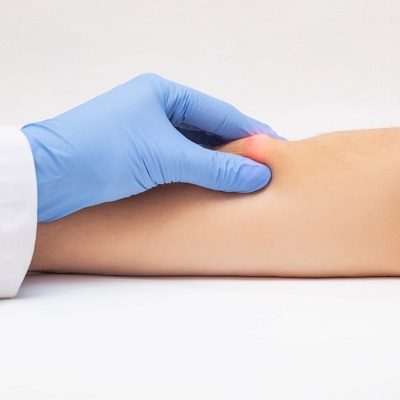 Best Lipoma Treatment in Islamabad, Rawalpindi & Pakistan Lipoma Cost