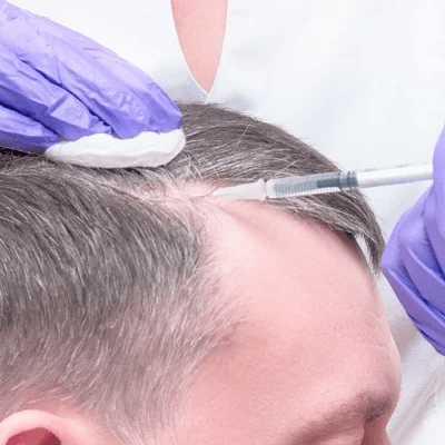 PRP Treatment for Hair Loss in Islamabad Pakistan