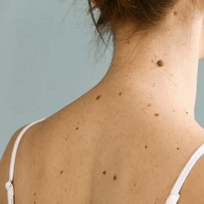 Warts Removal Cost in Islamabad