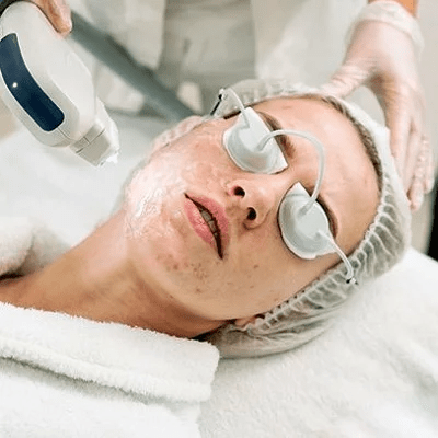 Can Laser Treatment Remove Acne Scars Completely?