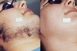 Cheapest Full Body Laser Hair Removal in Islamabad Pakistan