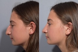 Closed Rhinoplasty Cost in Islamabad Pakistan