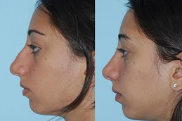 Closed Rhinoplasty in Islamabad Pakistan