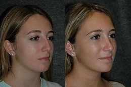 Closed Rhinoplasty in Islamabad & Rawalpindi