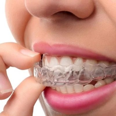 Crowded Teeth Treatment in Islamabad Pakistan Glamorous Clinic