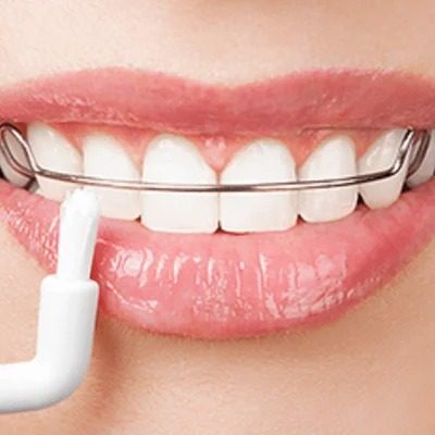 Dental Retainers in Islamabad, Rawalpindi & Pakistan Retainer Cost