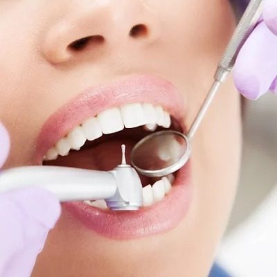 Dental Tooth Fillings in Islamabad Pakistan Cost & Price