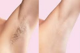 Full Body Laser Hair Removal Clinic in Islamabad