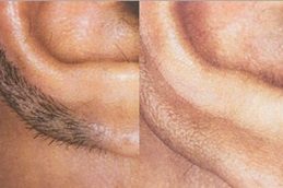Full Body Laser Hair Removal Cost in Islamabad & Rawalpindi
