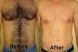 Full Body Laser Hair Removal Cost in Islamabad