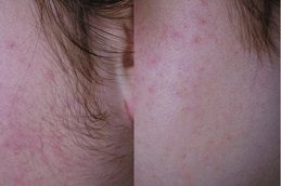 Full Body Laser Hair Removal Cost in Rawalpindi