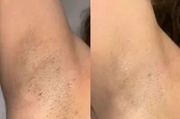 Full Body Laser Hair Removal before & After Islamabad