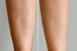 Full Body Laser Hair Removal before & After clinic Islamabad