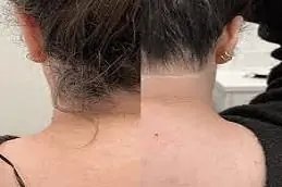 Full Body Laser Hair Removal before & After clinic treatment Islamabad