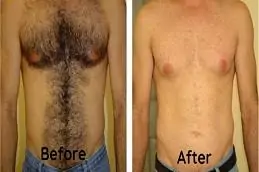 Full Body Laser Hair Removal before & After in Islamabad