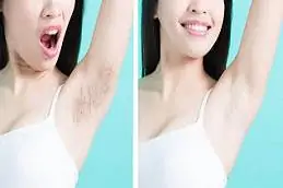Full Body Laser Hair Removal before & After treatment Islamabad