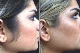 Full Body Laser Hair Removal in Islamabad, Rawalpindi & Pakistan