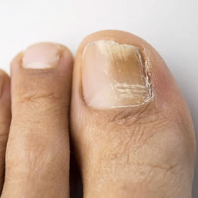 Fungal Nail Infections in Islamabad, Rawalpindi & Pakistan Cost