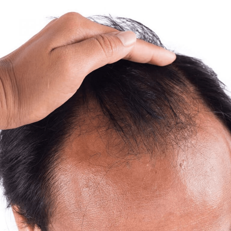 How Baldness Is Harmful To Your Emotions in Islamabad Price & Cost