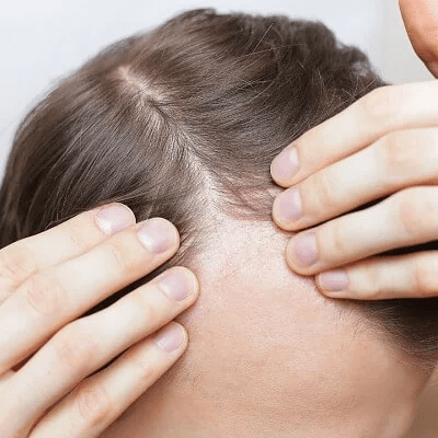 How To Say Goodbye For Baldness For Men & Women in Pakistan