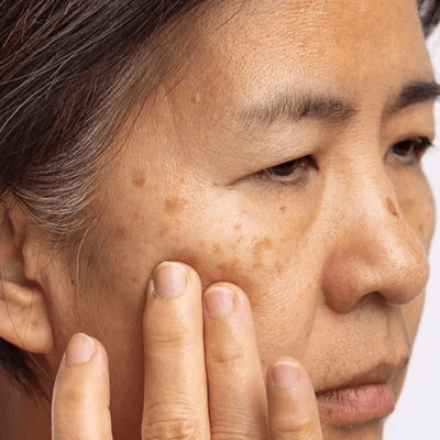 How to Treat Melasma?