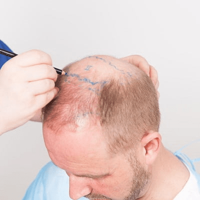 Is Hair Transplant Permanent?