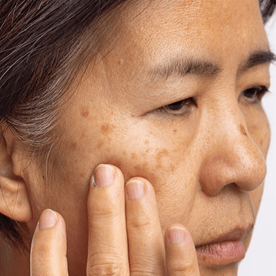 Melasma Treatment in Islamabad, Rawalpindi & Pakistan Melasma Cost