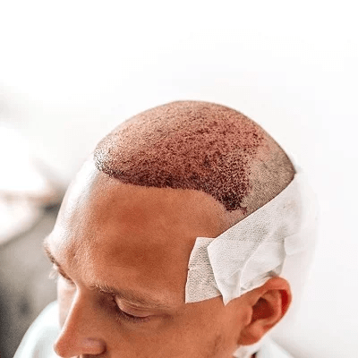 Per Graft Hair Transplant Cost in Islamabad & Pakistan Price