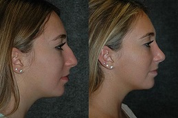 Price of Closed Rhinoplasty in Islamabad