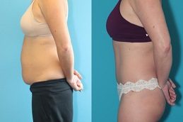 Result of Tummy Tuck in Islamabad