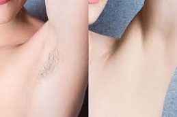Results OF Full Body Laser Hair Removal in Islamabad