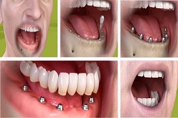 Results OF Full Mouth Dental Implants Islamabad