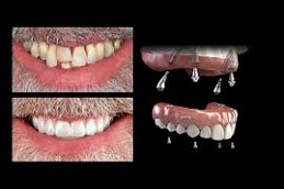 Results OF Full Mouth Dental Implants Pakistan