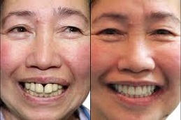 Results OF Full Mouth Dental Implants cost Pakistan