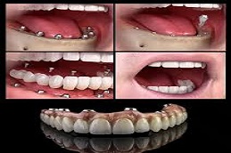 Results OF Full Mouth Dental Implants in Islamabad