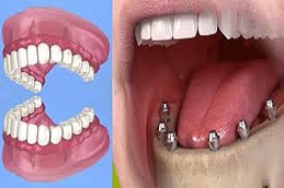 Results OF Full Mouth Dental Implants in Pakistan