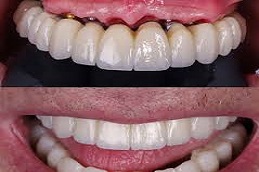 Results OF Full Mouth Dental Implants