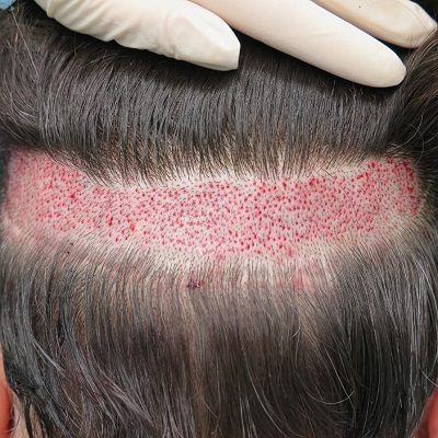 Robotic Hair Transplant in Islamabad, Rawalpindi & Pakistan Cost