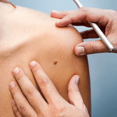 Skin Lesion Removal in Islamabad, Rawalpindi & Pakistan Cost