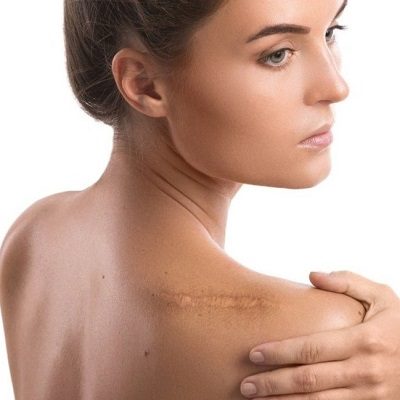 Surgical Scar Revision in Islamabad Pakistan Glamorous Clinic