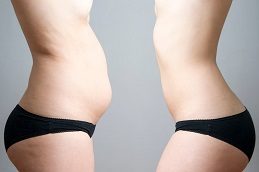 Tummy Tuck Before & After in Islamabad Pakistan